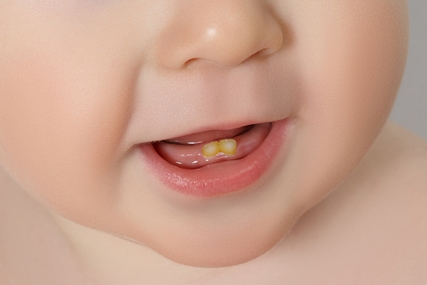 ضرورت مراجعه به واحدهای بهداشتی هنگام رویش اولین دندان کودک