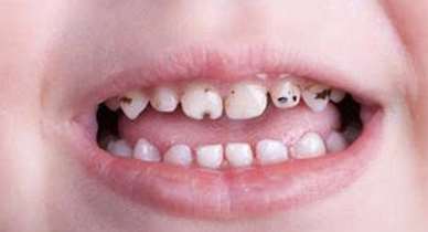  آهن دندان را سیاه می‌کند؛ گول تبلیغات را نخورید