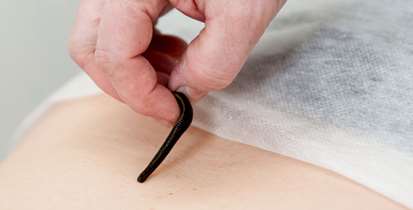 بایدها و نبایدهای زالو درمانی