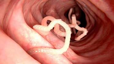 انگل‌هایی که رشد کودکان را مختل می‌کند