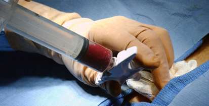 موفقیت تیم پیوند مغز استخوان بیمارستان طالقانی برای درمان بیماران خود ایمن متعدد