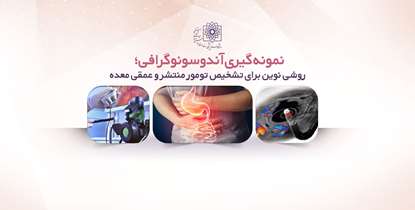 نمونه گیری آندوسونوگرافی؛ روشی نوین برای تشخیص تومور منتشر و عمقی معده