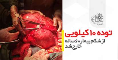 توده 10 کیلویی از شکم بیمار 60 ساله خارج شد